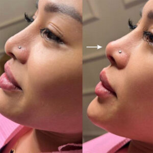 Liquid Rhinoplasty and Tear Trough Training